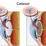 Chirurgia cataractei