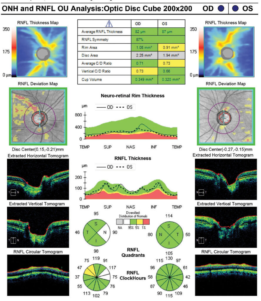 Axa Optic -zeiss oct image