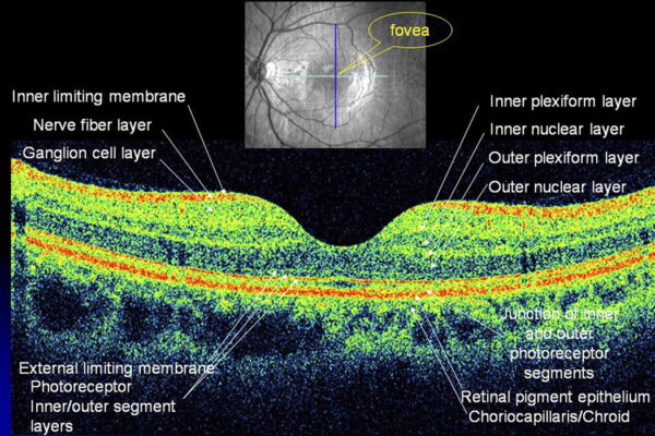 OCT – Tomografia in coerenta optica