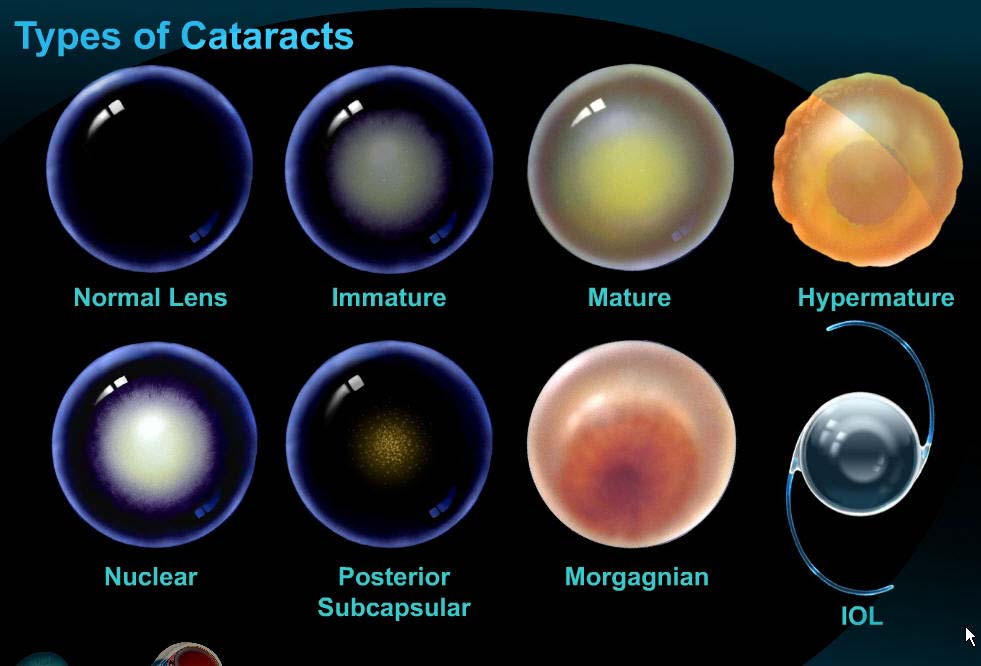 Tipuri de cataractă, ilustrație educațională