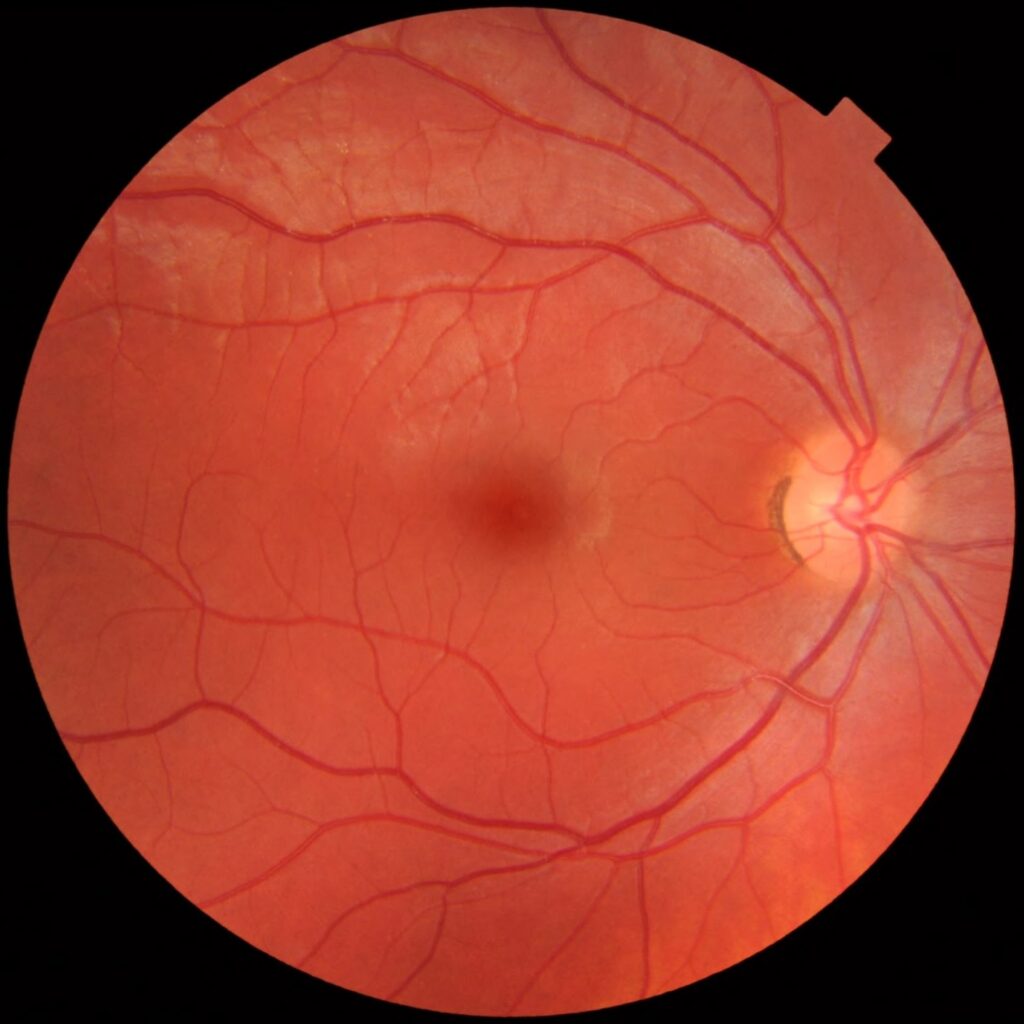 Fotografie de fund de ochi drept cu discul optic, macula și vasele retiniene