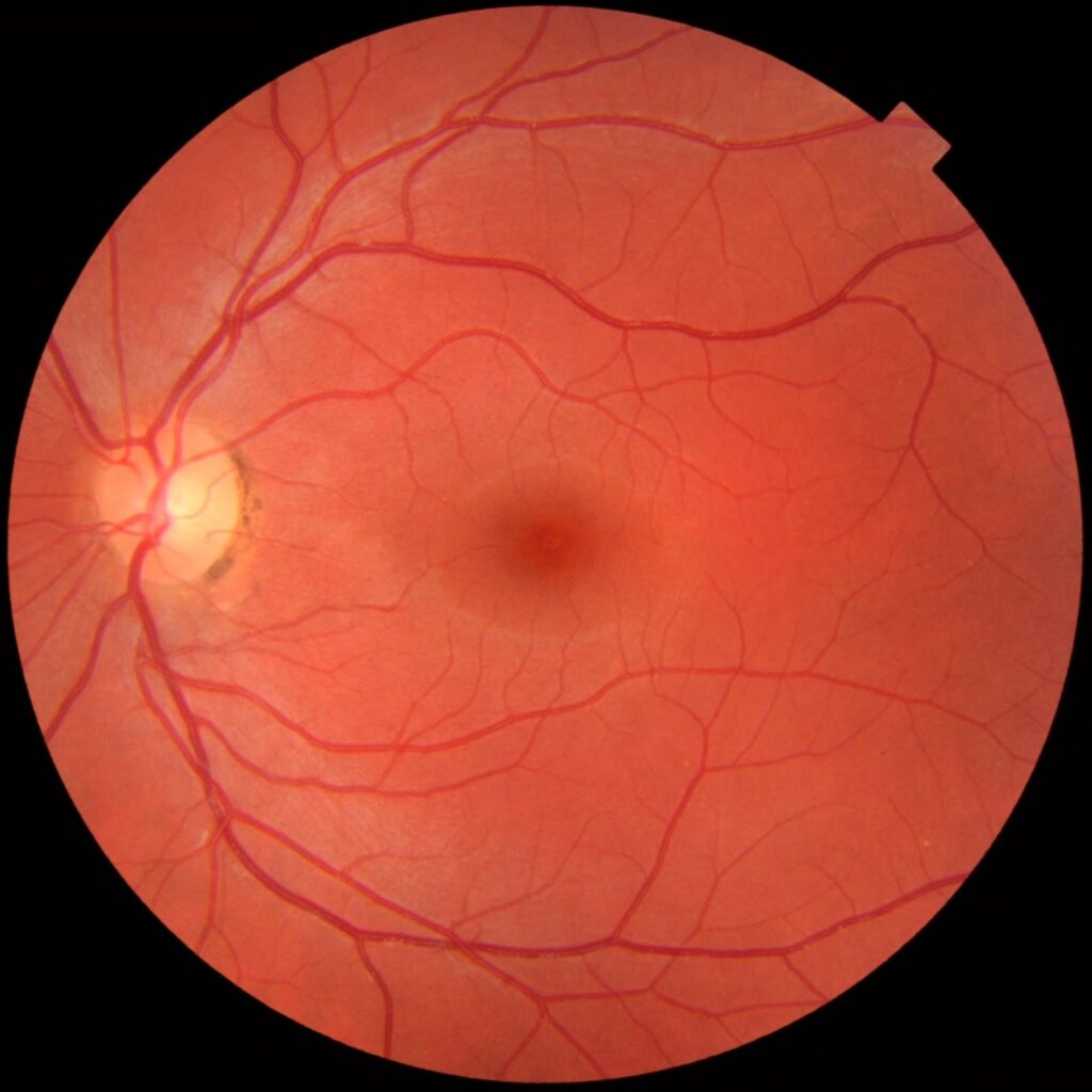 Fotografie de fund de ochi stâng cu discul optic, macula și vasele retiniene